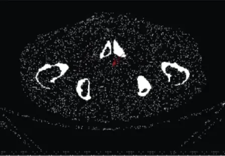 Fig. 3. Prostate in an Abdomen CT image slice 