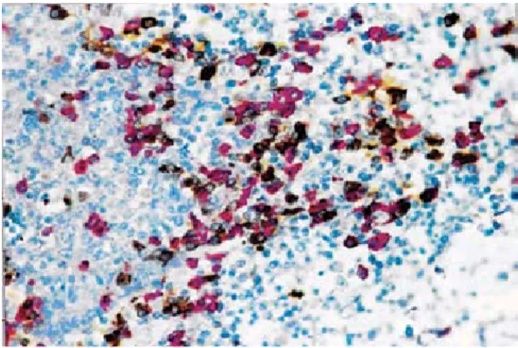 Figure 1. Sequential double staining method performed with the EnVision TM  G⎜2  Doublestain  Kit  using  polyclonal  anti-kappa  light  chains  (red)  and  polyclonal  anti-lambda light chains (brown) as primary antibodies