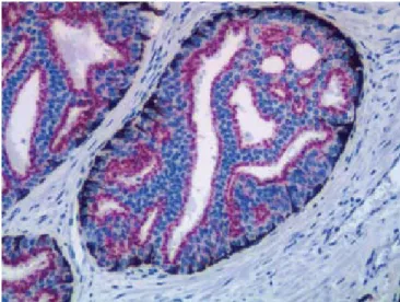 Figure  2.  Simultaneous  double  staining  performed  with  EnVision TM   DuoFLEX  using  an  antibody  cocktail  containing  monoclonal  rabbit  anti-AMACR  (red),  monoclonal  mouse  anti-HMWCK  and  monoclonal  mouse  anti-CK  5/6  (brown/