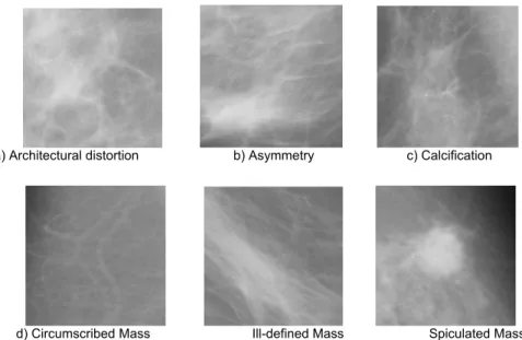 Figure 1: Abnormal mammograms are classified into calcification, architectural distortion, asymmetry,  circumscribed masses, speculated masses, and ill-defined masses