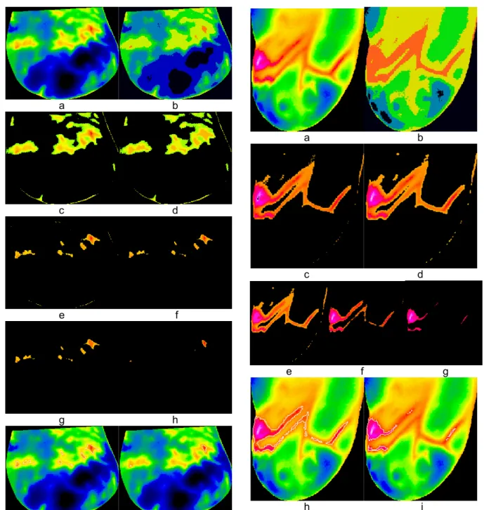 Figure 8: Thermogram of a breast cancer patient  4: (a) cropped breast, (b) result of first iteration of  minimum variance quantization, (c) hot region  with gap extracted after first iteration, (d) hot  re-gion without gap after applying dilation operator