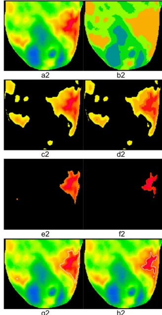 Figure 6: Thermogram of a breast cancer patient  1 and patient 2: (a1, a2) cropped breast, (b1, b2)  result of first iteration of minimum variance  quan-tization, (c1, c2) hot region extracted after first  iteration, (d1, d2) results of second iteration of