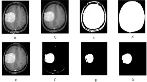 Figure 2: Tumor separation steps: (a) Original image, (b) filtering, (c) primary binary image, (d)  dilation and filling holes, (e) multiplying the gray in binary image, (f) ultimate binary image, (g)  erosion and removing low areas, (h) filling the holes 