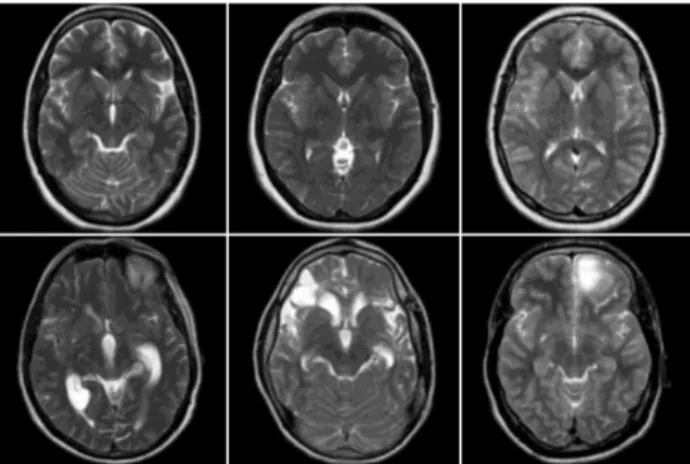 Figure 3 shows a sample of the MRI images of normal and abnormal brain images from the composed dataset