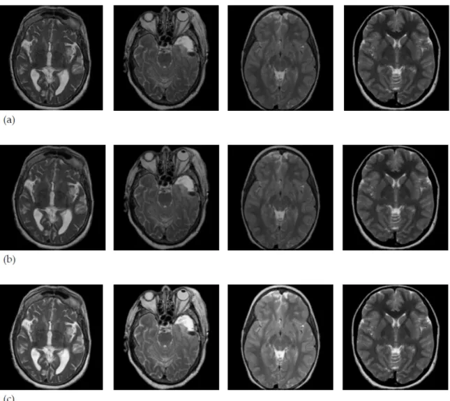 Figure 4. MRI brain images from the collected dataset (a) Original MRI images; (b) enhanced by the  Gaussian filter with kernel of (3 × 3); (c) normalized MRI.