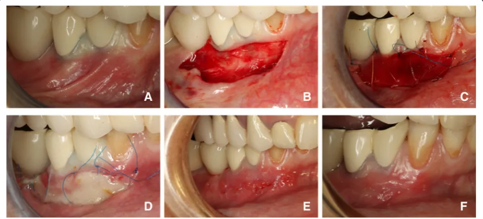 Fig. 1 Images describing the surgical procedure: a) initial situation with deficit of keratinized gingiva; b) mucosal fenestration with apicallypositioned flap; c) the collagen matrix sutured in place; d) one week after the surgery; e) ten days after the surgery, immediately after theremoval of the sutures; f) two weeks after the surgery