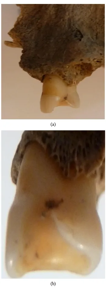 Figure 7. Unusual wear of the right first premolar (burial 6/2, ♀, 30 - 35 years). 