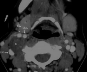 Fig 5. In this postcontrast axial CT image, the schwannoma separates the ICA and ECAalong a sagittal plane