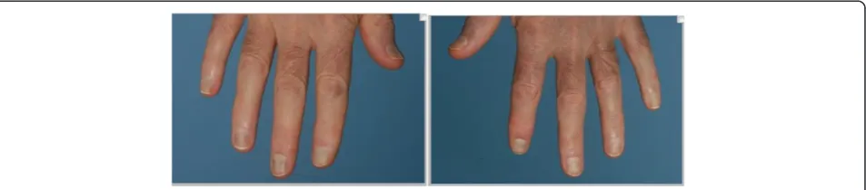 Fig. 1 Purple/blue discolouration of the left and right nail beds of the hands