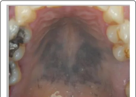 Fig. 2 Purple/blue dyspigmentation of the mucosa of the hard palate