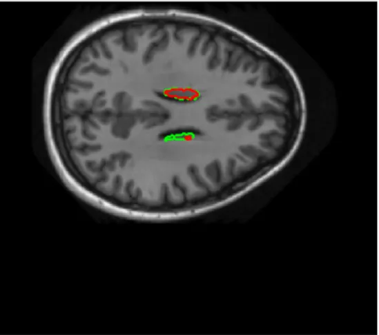 Figure 5.4: Axial view from a starting slice for the caudate segmentation where green is the manually segmented structure and red the automatic performing DDLS