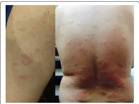 Fig. 1 Urticaria (hives)