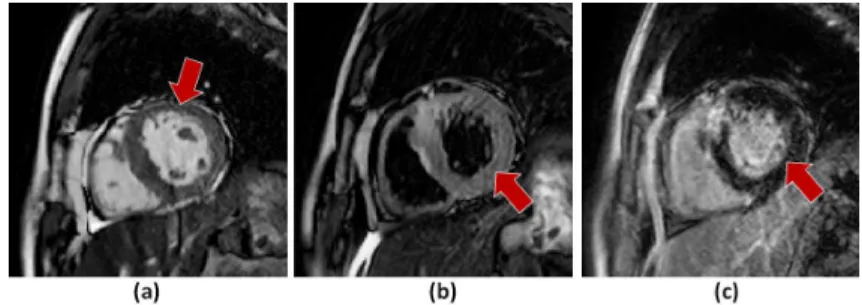 Fig. 1. Illustration of different CMR sequences: a) bSSFP slice, b) T2-weighted slice and c) LGE slice