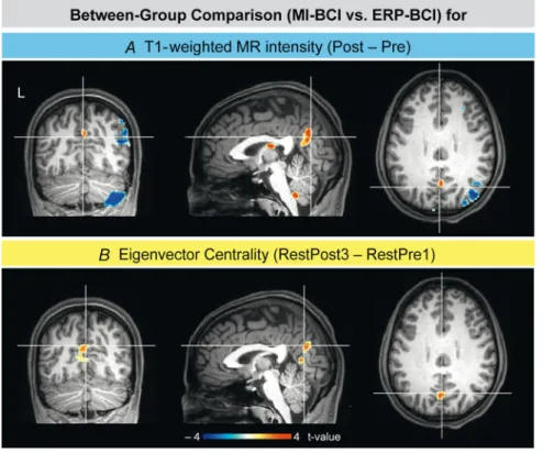 Figure 5. Between-group comparisons A, clusters of significant differences in T1-weighted MR intensity 