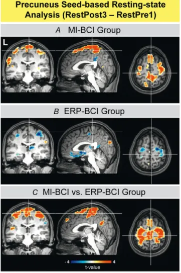 Figure 9. Seed-based analysis of the resting-state data with the seed region in the precuneus