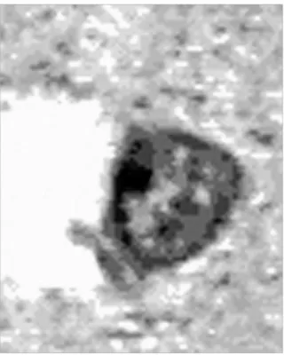 Figure 3.  Nerve cells with the second type of affection