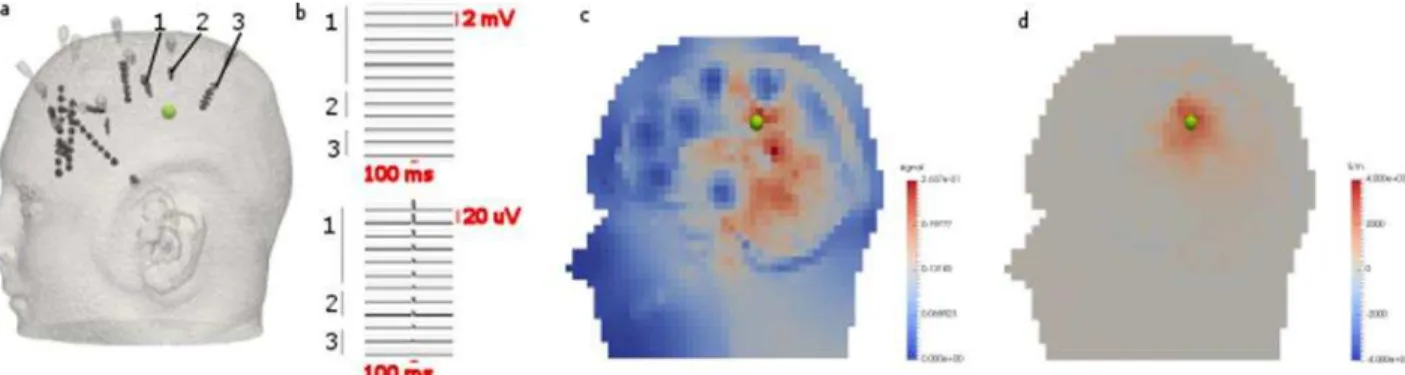 Figure 1. Illustration of an example of unsuccessful detection with SEEG (panel b) and inverse source modelling (panel c), even though  EIT  protocol  using  only  depth  electrodes  (panel  d)  still  reconstructed  the  perturbation  &lt;5mm
