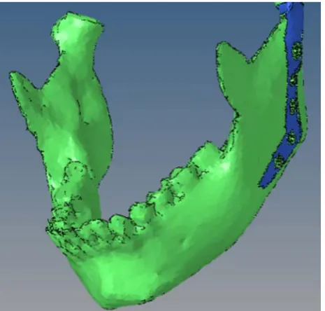 Fig. 2.  Mandible with TMJ prosthesis    