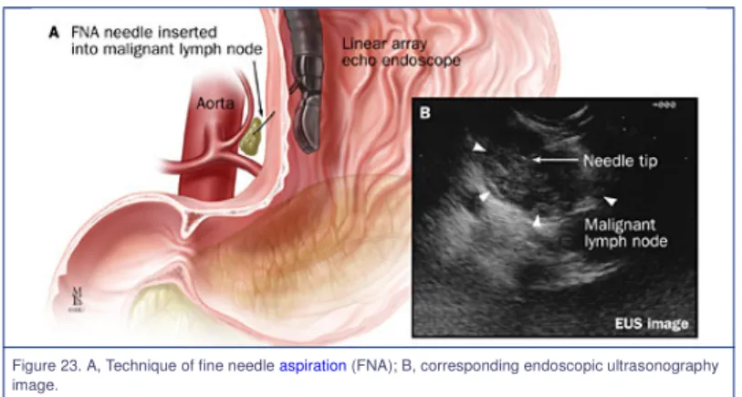 Figure 23. A, Technique of fine needle aspiration (FNA); B, corresponding endoscopic ultrasonography image.