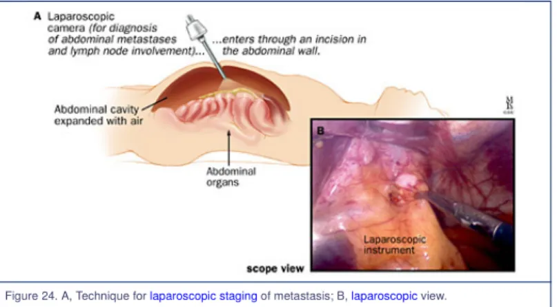 Figure 24. A, Technique for laparoscopic staging of metastasis; B, laparoscopic view.