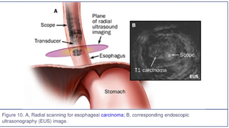Figure 10. A, Radial scanning for esophageal carcinoma; B, corresponding endoscopic ultrasonography (EUS) image.