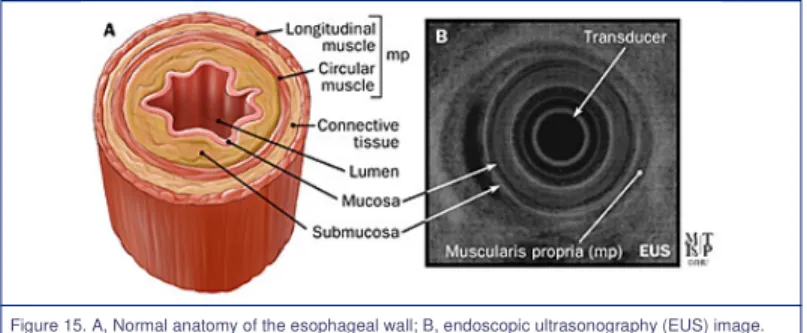 Figure 15. A, Normal anatomy of the esophageal wall; B, endoscopic ultrasonography (EUS) image.