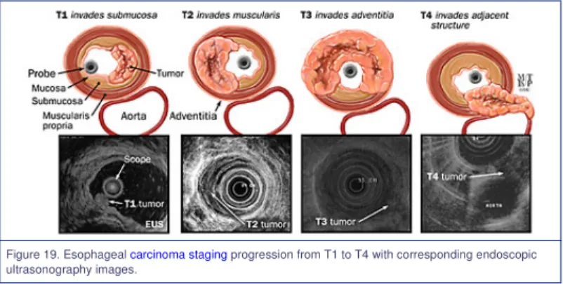 Figure 19. Esophageal carcinoma staging progression from T1 to T4 with corresponding endoscopic ultrasonography images.