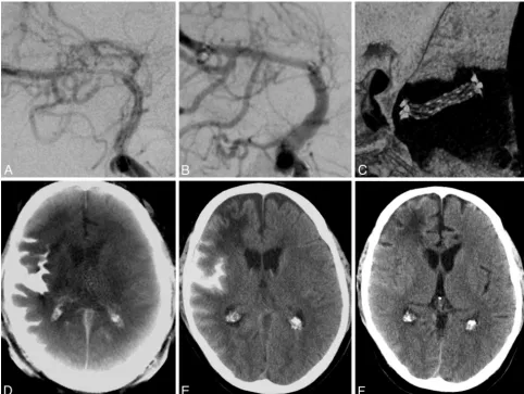 Fig 1. A, A 51-year-old man with a symptomatic middle cerebral artery stenosis. B, After percutaneous transluminal angioplasty and application of a Wingspan stent (Boston Scientific,Natick, Massachusetts), DSA depicts the successful vessel reconstruction