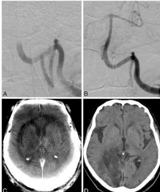 Fig 4. A, A 63-year-old woman with acute basilar artery thrombosis. B and C, After recanalization of the artery with a Penumbra System (Penumbra, Alameda, California) (B), an acuteischemic lesion of the right thalamus can be seen on the ACT images (C)