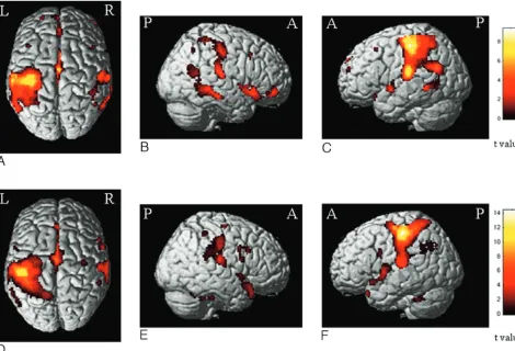 Fig 1. Areas showing BOLD changes in the within-group random-effects analysis (1-sample( t test, P � .001, uncorrected for display purposes) during the 2-back task in healthy controlsA�C) and patients with PPMS (D�F)