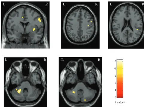 Fig 2. Areas showing increased activations in patients with PPMS in comparison with healthy controls during the analysis of the 2-back task (random-effect-analysis, ANOVA, P � .05corrected for multiple comparisons)