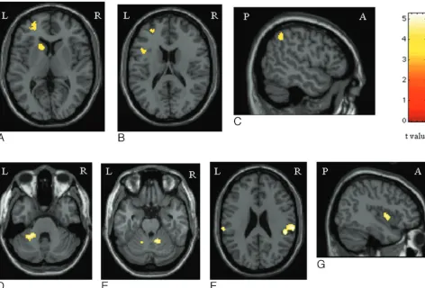Fig 3. Areas of increased activations in patients with PPMS without cognitive impairment vs