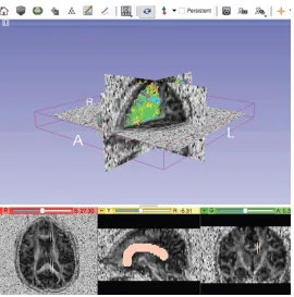 Figure 2. Screen capture of image from 3DSlicer – Top: DTI data displayed as linear paths
