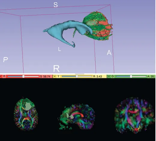 Figure 8. Screen capture of image from 3DSlicer - Brain ventricle and tumor data (cystic and non-cystic) visualized as a 3D volume