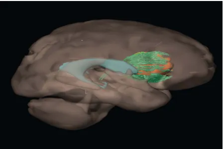 Figure 11. Screen capture of image from MAYA - Brain ventricle, tumor and Diffusion Tensor Tractography (DTI) data – Prototype model