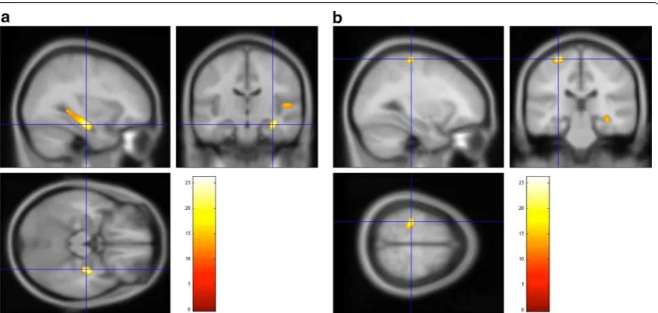 Table 3 VBM analysis including  association of  variance between  5-HTTLPR polymorphisms and  GM volumes in  OCD patients and HCs