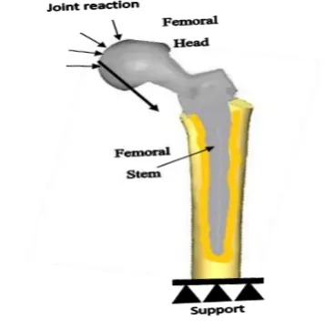 Fig. 3.  Femoral implant simulation 