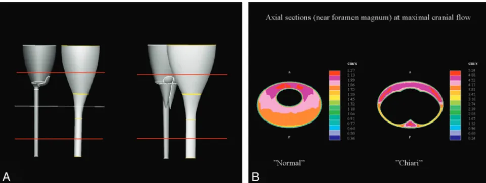 Fig 7. Idealized models (above) of the brain, spinal cord, and SAS for simulating CSF flow in a healthy subject (left) and in a patient with Chiari (right)