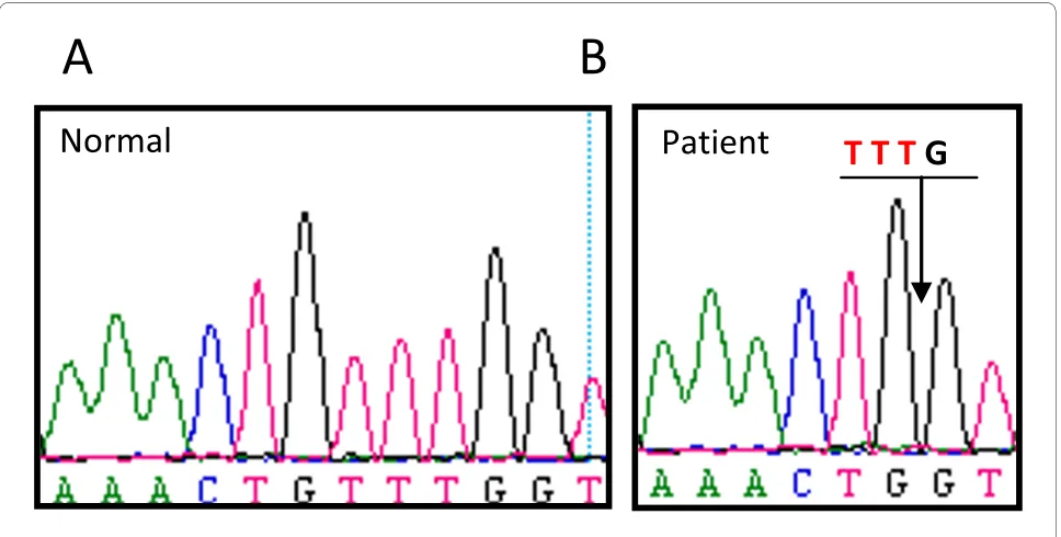 Figure 2 Electropherogram of the BTK gene in a normal donor (A) and patient (B). A TGTT deletion in exon 16 leads to a frameshift resulting in a premature stop codon in the BTK gene (g.66795_66798delTTGTT, c.1581_1584delTTTG).