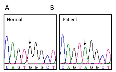 Figure 3 Electropherogram of the CD40L gene in a normal donor (A) and patient (B). A point mutation in exon 5 leads to a premature stop codon in the CD40L (c.475G > A, p.W140X).