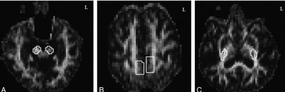 Fig 1. Seed region and ROI placement on GFA maps at the (A) CP and (B) M1 in the TS analysis and at the (C) PLIC in the ROI-based analysis of bilateral CSTs corresponding to the lowerextremity motor control in a patient with moderate stroke.
