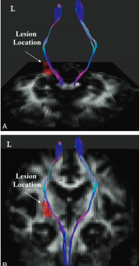 Fig 2. Tractography of bilateral CSTs corresponding to lower extremity motor control in apatient with ischemic stroke at the left PLIC (red area)