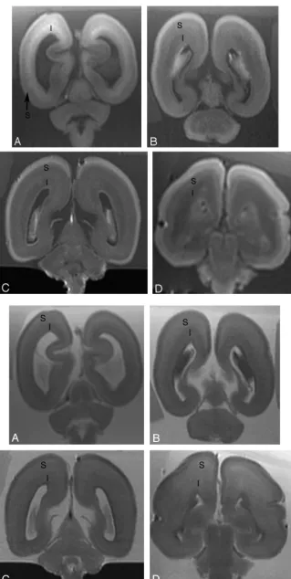 Fig 2. Postmortem coronal T1-weighted images at (A) 18weeks, (B) 22 weeks, (C) 23 weeks, and (D) 25 weeksgestational age
