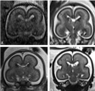 Fig 8. Antenatal coronal T2-weighted images at (A) 20weeks, (B) 22 weeks, (C) 23 weeks, and (D) 25 weeksgestational age