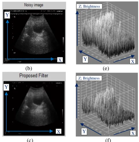 Fig. 4: Abdomen image; a) Original image, b) Noisy Image, c) Filtered by proposed technique, d) Interactive 3D surface plot of original image, e) Interactive 3D surface plot of noisy image, f) Interactive 3D surface plot of filtered image