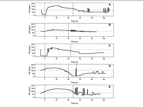 Figure 1 Heart rate curves during electroconvulsive therapy. Horizontal gray lines, baseline heart rate; dotted vertical lines, end ofstimulation; broken vertical lines, end of motor seizure