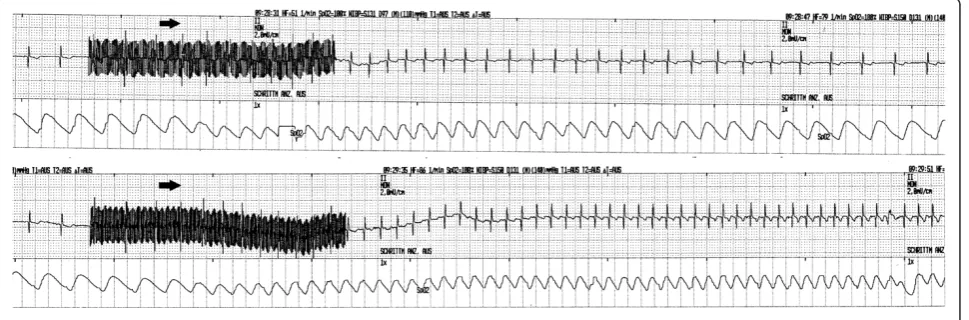 Figure 3 Sympathetic surge during subconvulsive and convulsive bifrontal stimulation. The figure shows ECT no