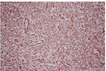 Figure 1: Preoperative CT scan showing a large, solid mass in the liver.