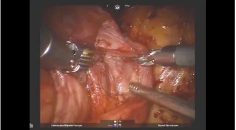 Fig. 1. A screenshot reference taken from video footage of Surgery 1. 
