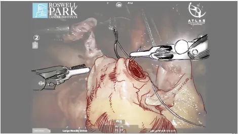 Fig. 5. A final illustration for Surgery 2. 